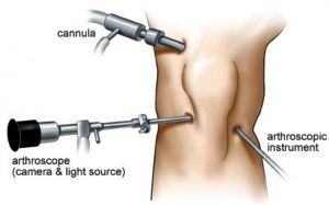 Artroscopia de rodilla para meniscectomía, o retirar una parte del menisco. 