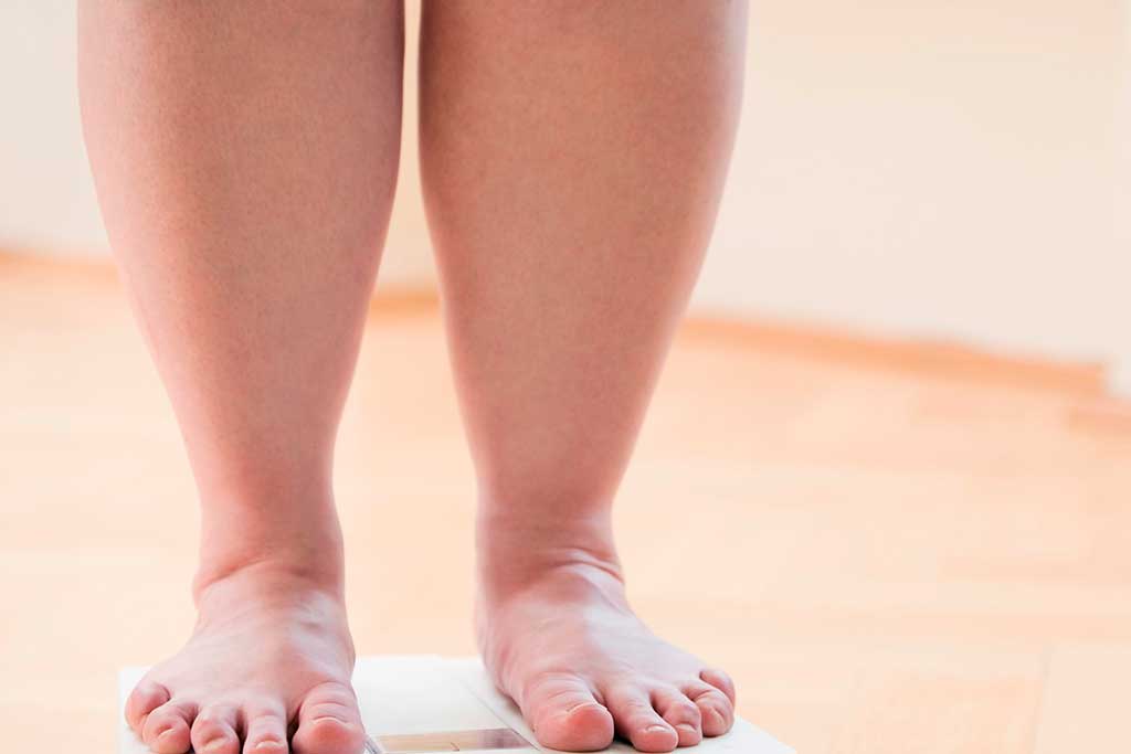 El sobrepeso ayuda en el avance de la Artrosis